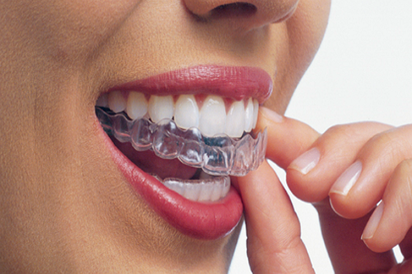 invisalign in chilliwack