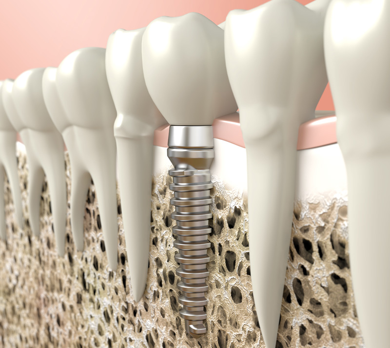 dental implants in chilliwack