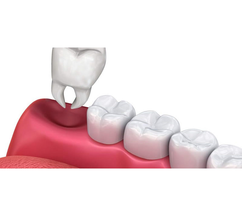 tooth extractions in chilliwack