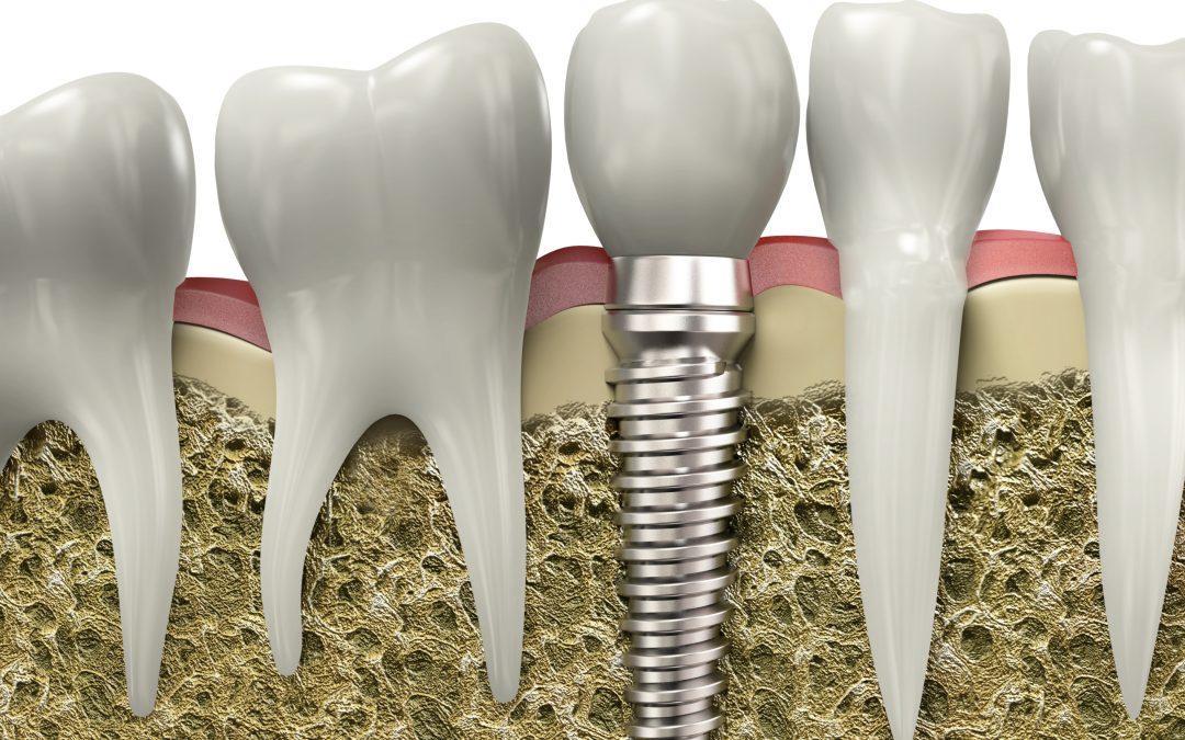 How Dental Implants Have Evolved to Benefit Patients